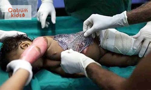  Chữa bỏng bằng da cá rô phi là bước tiến quan trọng của nền y học Brazil