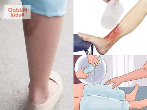  Vết thương bỏng bô xe cần được làm mát để dịu cảm giác đau rát