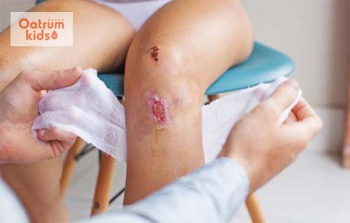  Vết thương bỏng bô xe máy chảy nước vàng cần được chăm sóc đúng cách để tránh bội nhiễm