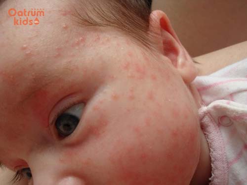 Khoảng 30% trẻ bị chàm sữa