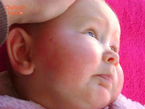Chàm sữa liên quan mật thiết đến yếu tố dị ứng