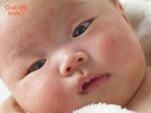 Chàm sữa là bệnh viêm da thường gặp ở trẻ