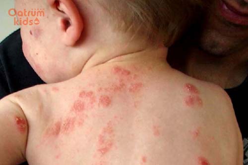 Bệnh thường tái phát nhiều lần, không thể loại bỏ được nguyên nhân gây bệnh