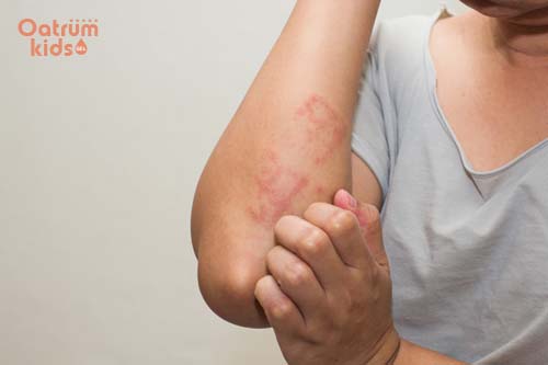 Bệnh eczema – Căn bệnh viêm da không thể coi thường