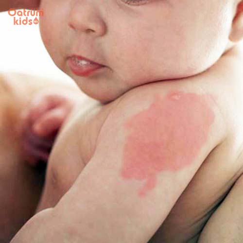Chàm đỏ có thể xuất hiện ở mọi vị trí trên cơ thể trẻ