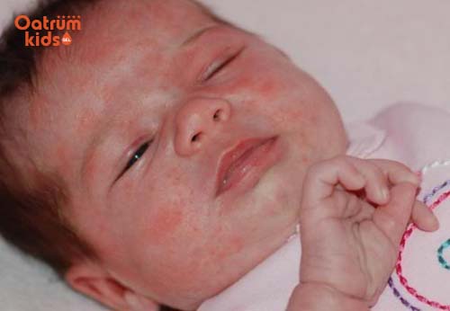 Món ăn cũng là một bài thuốc chữa chàm sữa cho bé hiệu quả