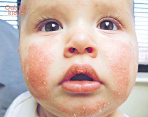 Rất khó để xác định rõ nguyên nhân vì sao bé bị lác sữa