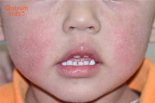 Nhưng chàm sữa rất khó chữa trị dứt điểm