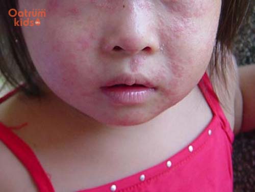 Chàm sữa là bệnh không lây truyền