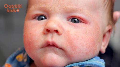 Chàm sữa thường gặp ở nhiều trẻ nhỏ