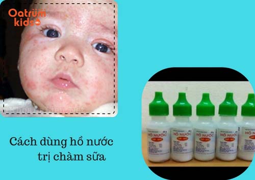 Hồ nước thường được chọn mặt gửi vàng để trị chàm sữa cho trẻ