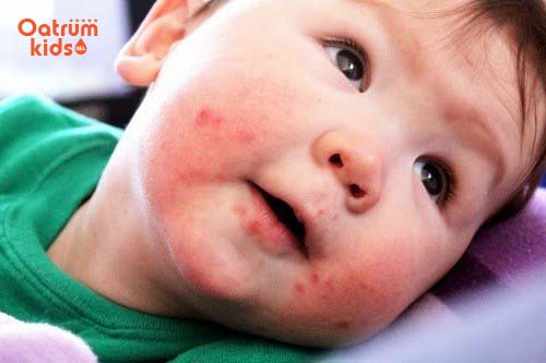 Dầu cám gạo trị chàm sữa cho trẻ - Nhiều trẻ bị chàm sữa khỏi bệnh nhờ dầu cám gạo