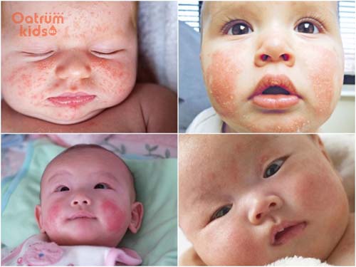 Chàm sữa ở trẻ liên tục tái phát là do cơ địa dị ứng và yếu tố dị ứng