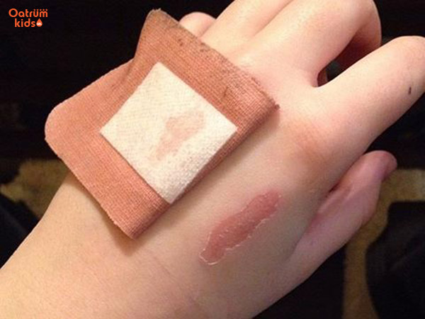 Không bôi kem trị muỗi đốt lên vùng da xuất hiện vết thương hở