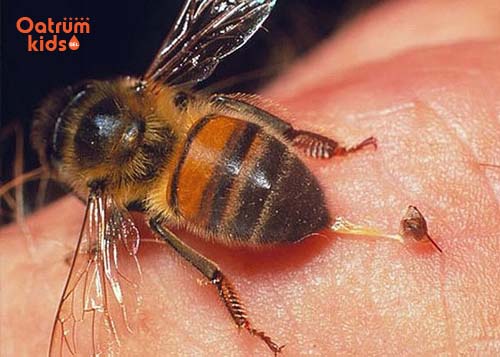 Cần lấy nọc độc của côn trùng khỏi da trẻ