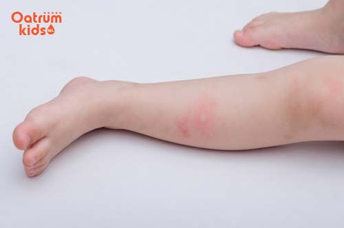 Làn da mỏng manh nên trẻ thường bị mẩn đỏ khi côn trùng đốt