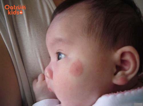 Mọi trẻ nhỏ có thể là “nạn nhân” của côn trùng