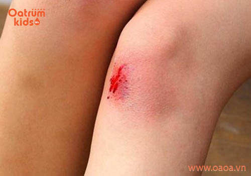 Vết trầy xước da ở trẻ không được sát trùng sẽ rất nguy hiểm