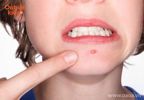 Trẻ bị mụn bọc ở cằm do cha mẹ vệ sinh da không đúng cách hoặc chế độ dinh dưỡng thiếu hợp lý