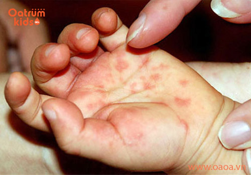 Mụn nước ở tay trẻ có thể mọc riêng rẽ hoặc từng cụm