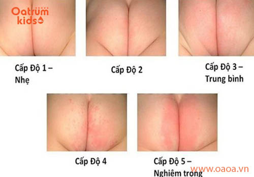 Các cấp độ hăm tã ở trẻ mọi mẹ nên biết - Trẻ bị hăm tã