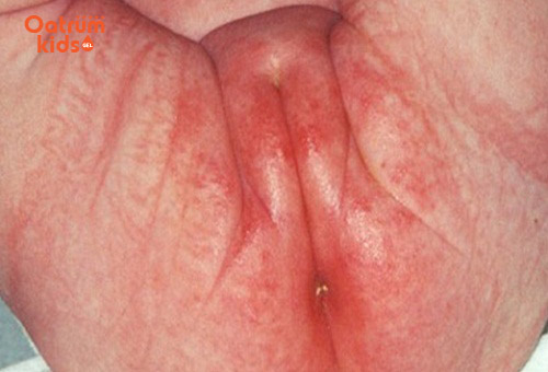 Háng là khu vực rất dễ bị hăm tấn công - Trẻ bị hăm háng