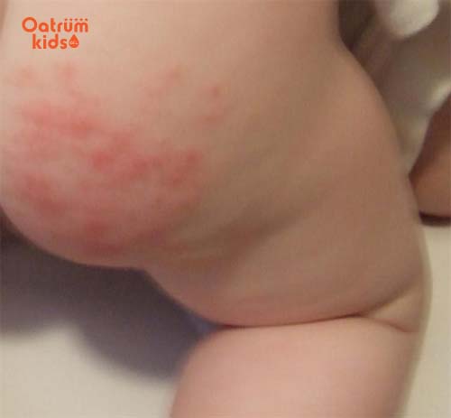 Trẻ bị mẩn đỏ ở mông là dấu hiệu của nhiều loại bệnh