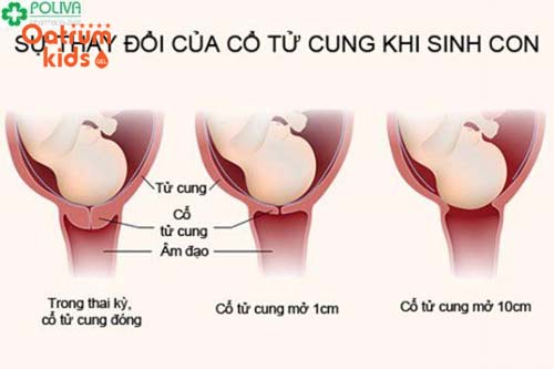   Trẻ sinh ra vẫn còn nằm nguyên vẹn trong bọc ối