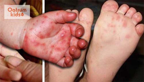  Bệnh chân tay miệng ở trẻ sơ sinh