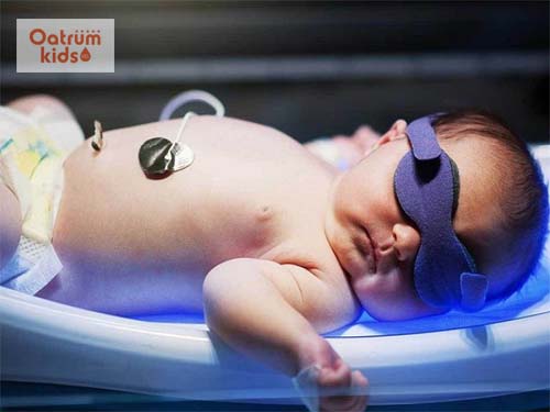  Chiếu đèn là phương pháp giúp chuyển hóa Bilirubin trong máu hiệu quả