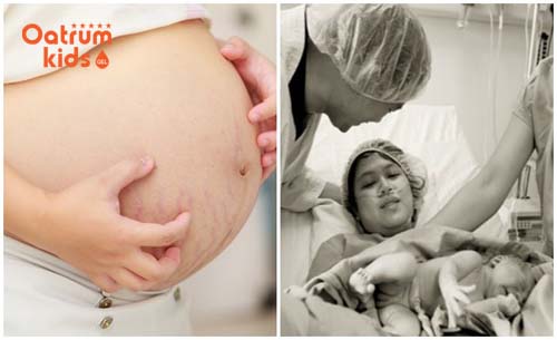  Bụng bầu tụt khiến mẹ đi lại nặng nề hơn