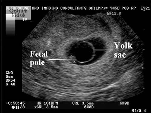 Bắt đầu từ tuần thứ 5 đã có thể siêu âm thấy túi thai.
