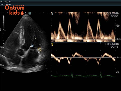  Các bé trai thường có nhịp tim chậm hơn với các bé gái.