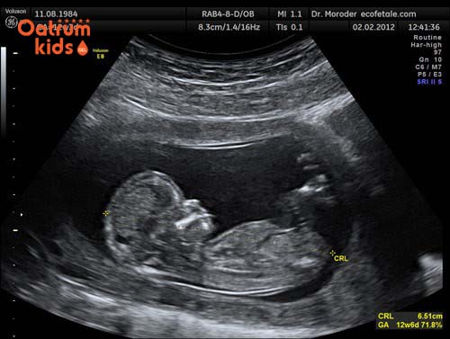 Chiều dài xương mũi thai nhi còn tuỳ thuộc vào tuổi thai và di truyền.