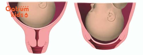  Cổ tử cung mở nhưng không đau bụng