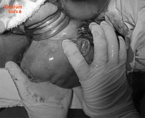 Hình ảnh em bé chào đời khi dây rốn quấn quanh cổ nhiều vòng