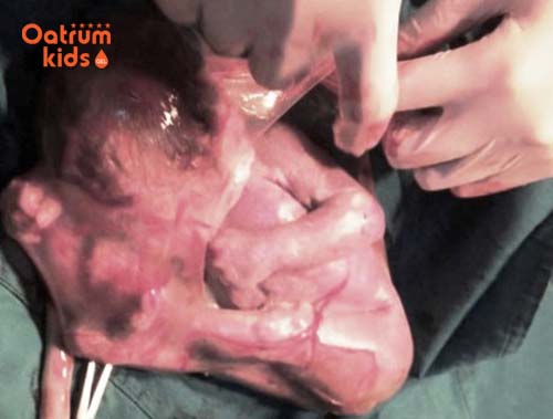  Bác sĩ cần rạch ối nhanh chóng tránh để em bé bị ngạt