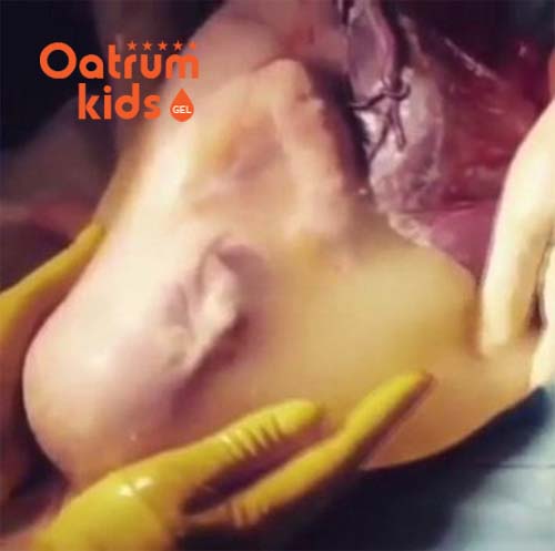  Thông thường thai bọc ối sẽ bị vỡ ra khi chịu lực ép của tử cung nhờ những cơ gò