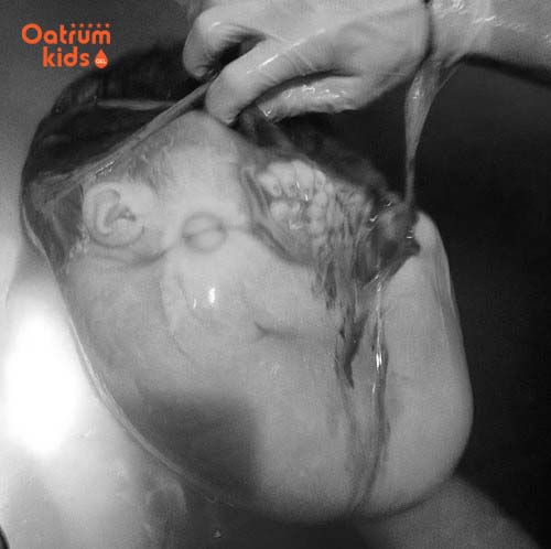  Đẻ bọc điều các bác sĩ cần nhanh chóng rạch túi ối để tránh em bé bị suy hô hấp