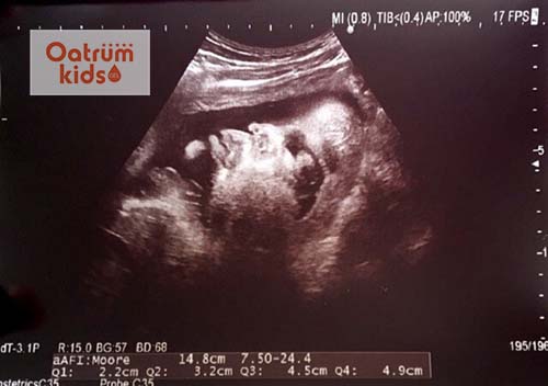  Thai 31 tuần tuổi đã có thể tự sản xuất tế bào hồng cầu từ gan.