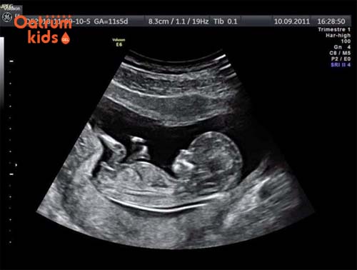  Cách tính tuổi thai dựa vào hình ảnh siêu âm