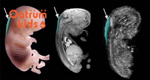 Khoảng sáng sau gáy từ 2,5-3,0 mm được xem là bình thường.