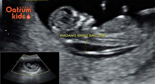 Đo khoảng sáng sau gáy giúp chẩn đoán hội chứng Down ở trẻ.