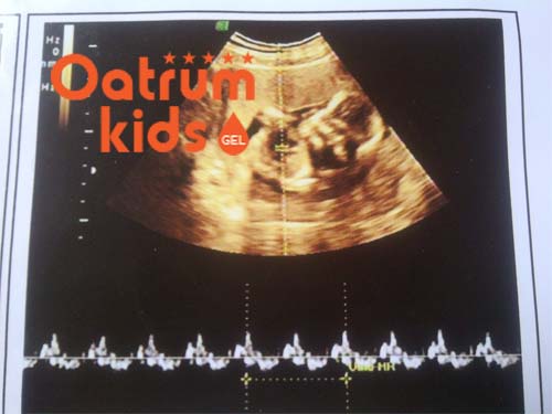  Thiết bị siêu âm kém chất lượng cũng có thể gây chẩn đoán sai tim thai.