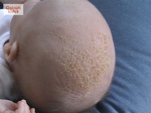 “Bệnh cứt trâu” có thể lây lan sang các vùng da khác.