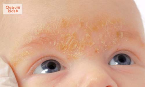 Lông mày, da đầu bé có vảy là dấu hiệu của bệnh cứt trâu