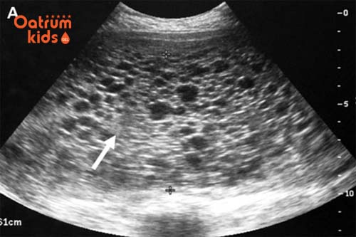 Thai 2 tuần tuổi vẫn chưa vào bên trong tử cung.