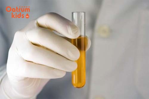  Màu nước tiểu đậm là dấu hiệu nhận biết mang thai bé gái sớm nhất