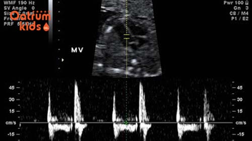  Nhịp tim thai nhi dao động 120-160 nhịp/phút là bé đang phát triển tốt.