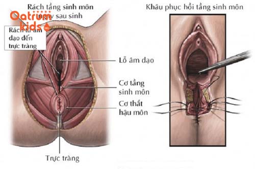  Rạch tầng sinh môn đúng thời điểm và đúng vị trí.